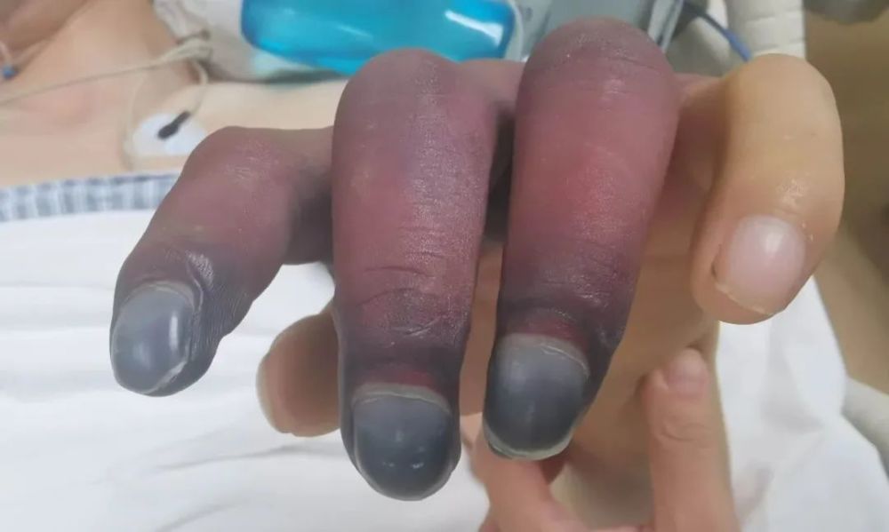 年轻小伙蹲着干活,起身后出现大块淤斑,手指坏死等待截肢!