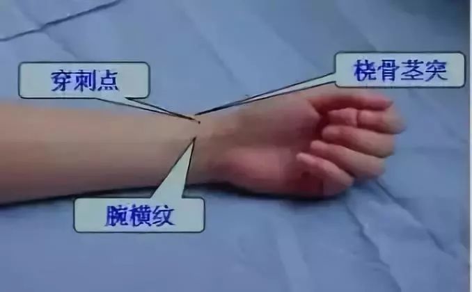 桡动脉穿刺位置的图示图片