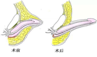 隐匿型阴茎需要手术吗?手术最佳年龄