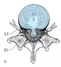 腰椎间盘突出|干货：椎间盘突出的程度及具体辨析