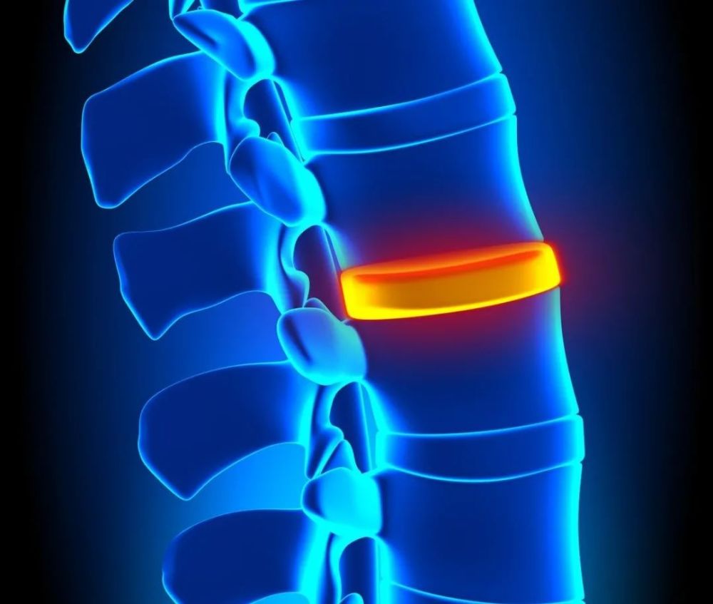 腰椎间盘突出|干货：椎间盘突出的程度及具体辨析