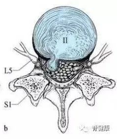 腰椎间盘突出|干货：椎间盘突出的程度及具体辨析