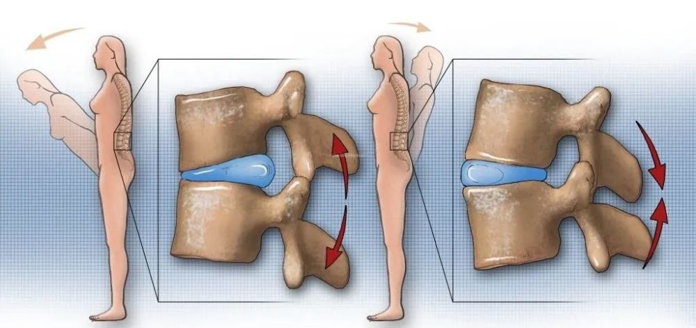 腰椎间盘突出|干货：椎间盘突出的程度及具体辨析