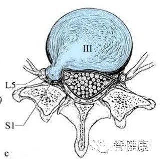 椎間盤膨出的影像學定義為突出部分>椎間盤邊緣的25%,或者突出的兩邊