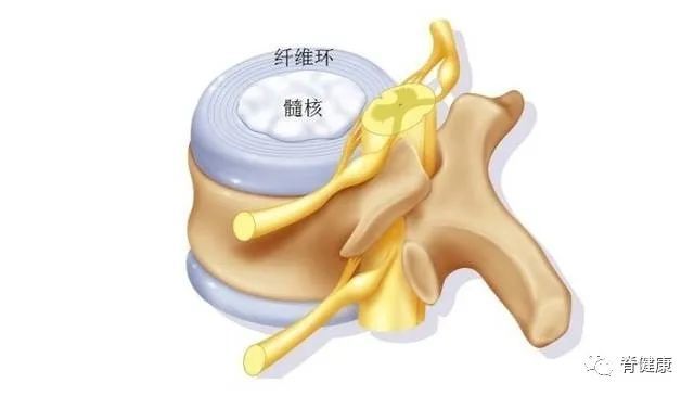 腰椎间盘突出|干货：椎间盘突出的程度及具体辨析