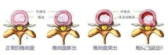 腰椎间盘突出|干货：椎间盘突出的程度及具体辨析