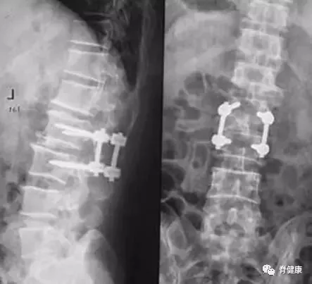 腰椎间盘突出|干货：椎间盘突出的程度及具体辨析