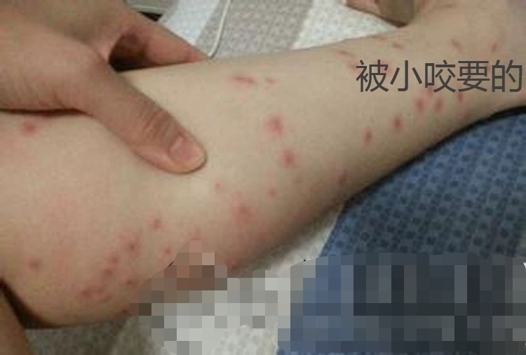 小黑虫咬人奇痒无比,比黑花蚊子还厉害,一招教你如何防治!_腾讯新闻