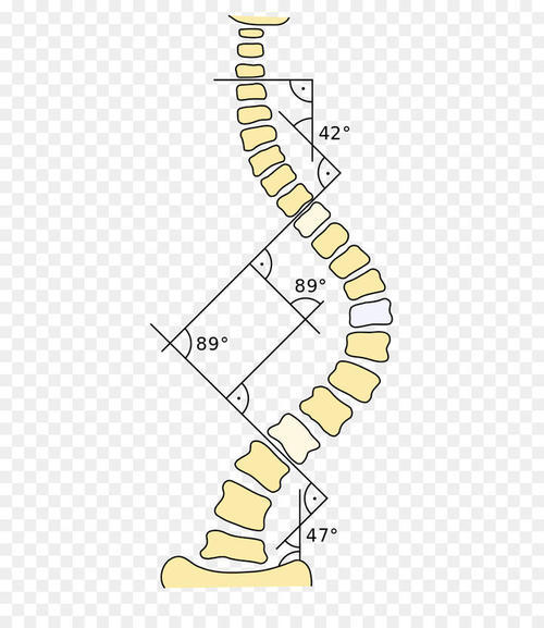 它是根據美國整形外科醫生john robert cobb命名的,是脊柱側彎角度