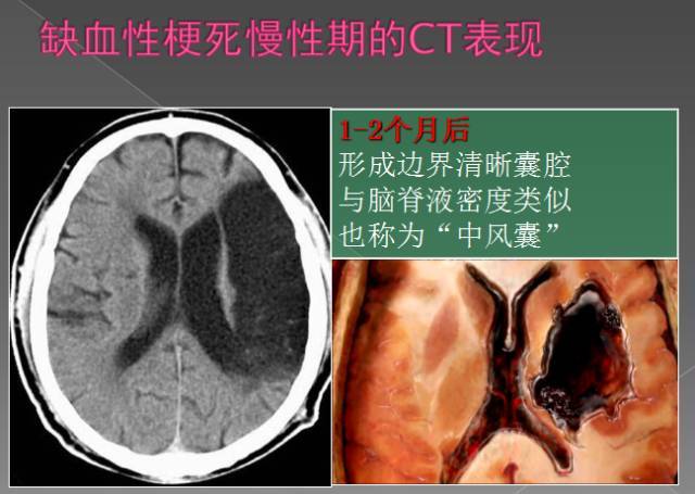 缺血性脑梗死2-3周病灶中心出现坏死,血脑屏障渗透性增加,水肿消退,ct