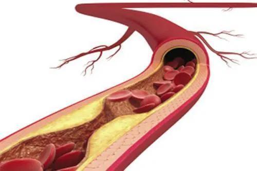 2型糖尿病|大部分2型糖尿病可逆转，都是因为它，高血脂高血压和它也有关系
