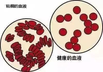 2型糖尿病|大部分2型糖尿病可逆转，都是因为它，高血脂高血压和它也有关系