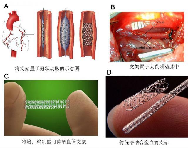 冠心病支架的释义手术费用和风险以及使用寿命