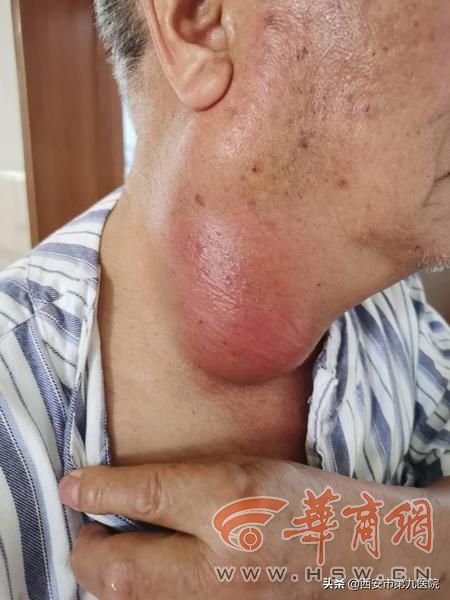 西安一老人被诊断出腮腺囊肿 医生:颈部异常要尽快就医