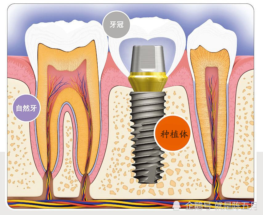 什麼是種植牙?種植牙貴不貴