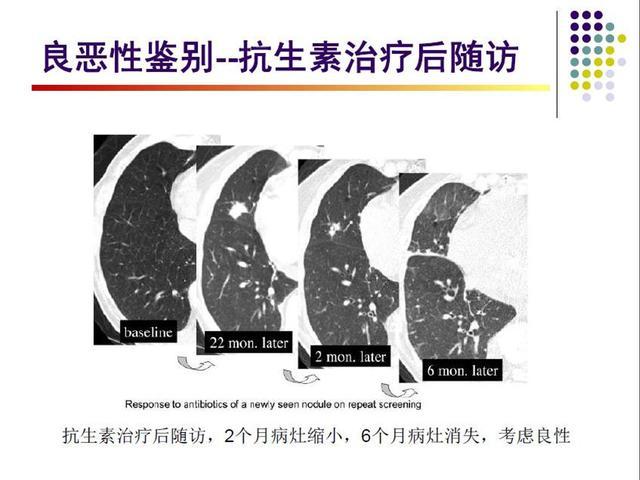 结节|肺结节可以通过吃什么散结？医生：只有一种情况下可以