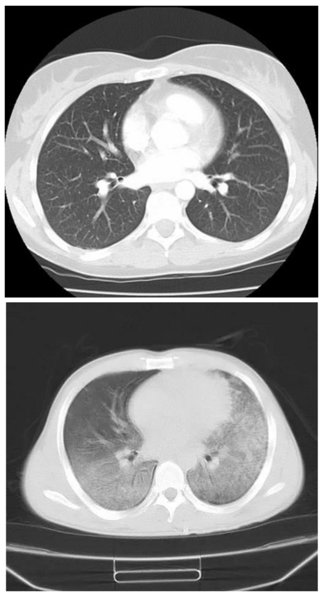 新冠肺炎肺部影像图片