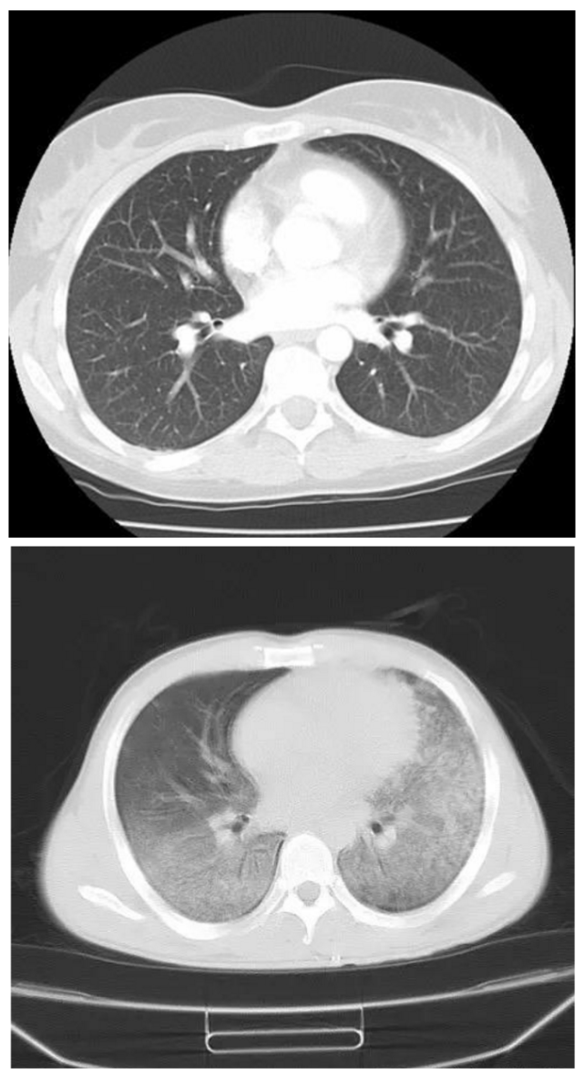 新冠肺炎肺部照片图片