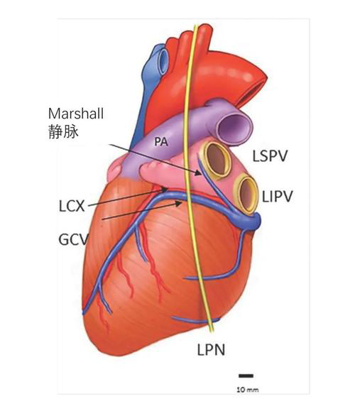 传统marshall 韧带消融是通过开胸或者穿刺心包腔的途径,但这两种方法
