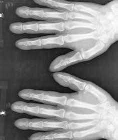 有了杵状指真的就是得了肺癌听听医生怎么说