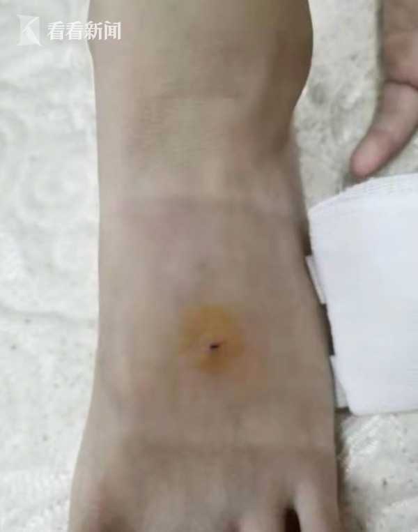 小学生将铅笔扎进8岁女同学脚背差点伤到脚筋