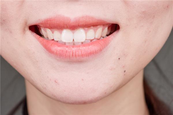 牙缝中抠出来的软软黄泥，究竟是什么？