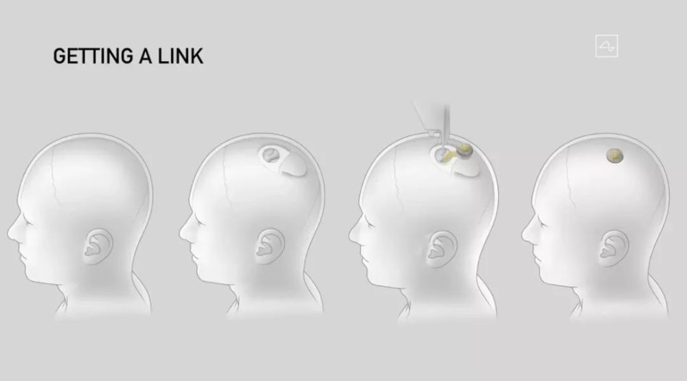 伊隆·马斯克|马斯克的最新脑机接口设备有啥独特之处？