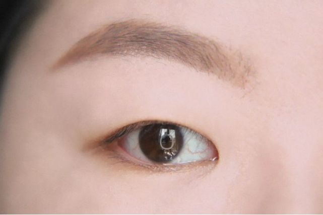 眼部脂肪比较肥厚,而且有严重的内眦赘皮,妥妥的一个肿眼泡单眼皮
