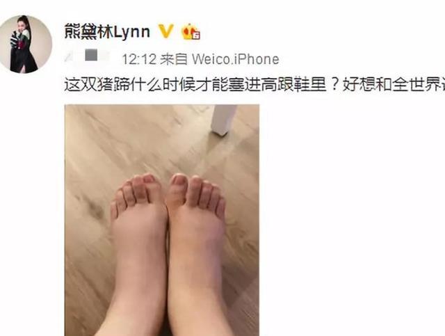 熊黛林生完双胞胎女儿后 脚肿成猪蹄 妇科专家给出消水肿的方法 腾讯新闻