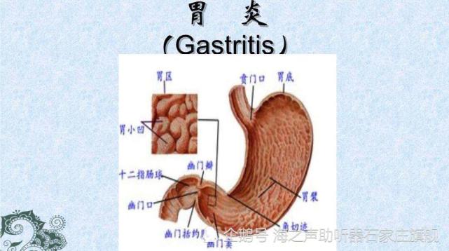 胃酸不足和胃酸多的区别 胃酸 胃酸过多 萎缩性胃炎 消化不良