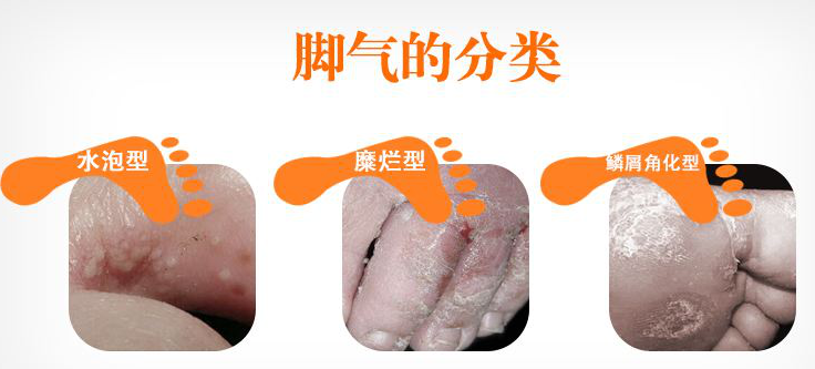 怎么判断是脚气,脚上起白色的空心小洞,脚气痒起来真难受!