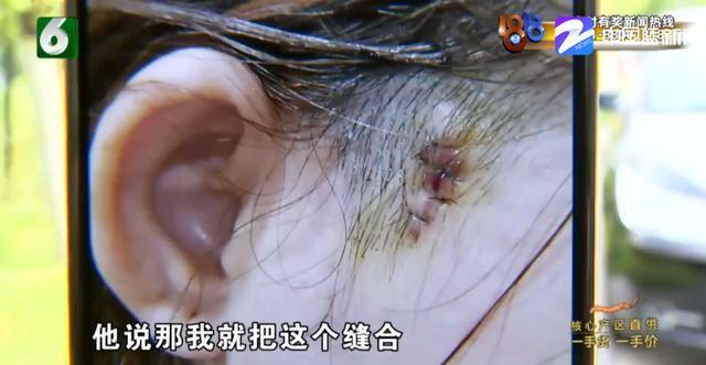 美容院女老板做线雕结果鬓角起痘流脓负责人伤口护理不当