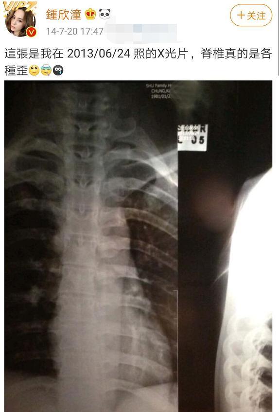 钟欣潼|阿娇受伤照曝光，伤口达6cm共缝了数十针，新戏或因此受影响