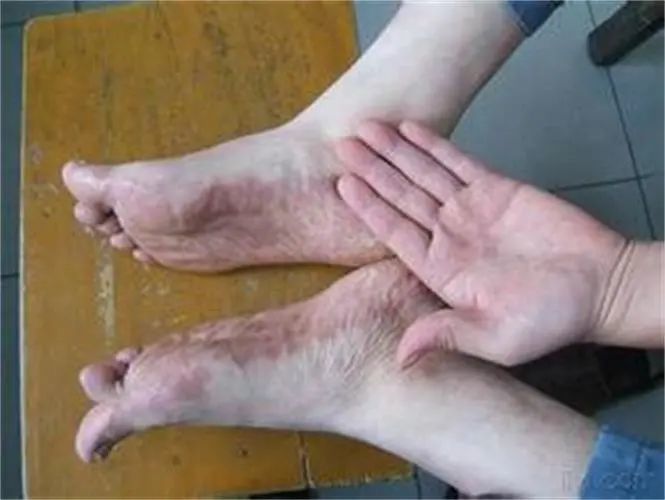 【杏林微科普】你是否因鹅掌风,香港脚而烦恼?