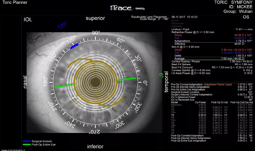 术后像差起源,筛查圆锥角膜(细分角膜地形图,itrace视功能分析仪