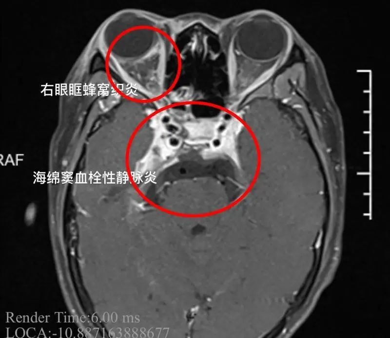 颅内感染|挤了一颗痘引发颅内感染！医生：长在这个区域的痘痘别乱挤