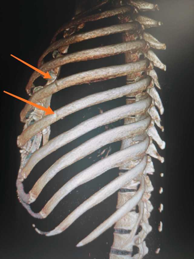 肋骨骨折一定需要手术 这几个因素是关键 肋骨骨折 肺部感染 呼吸衰竭 手术治疗