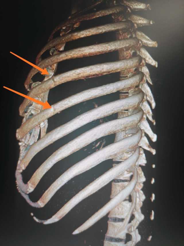 肋骨骨折一定需要手术 这几个因素是关键 肺部感染 呼吸衰竭 手术治疗 肋骨骨折