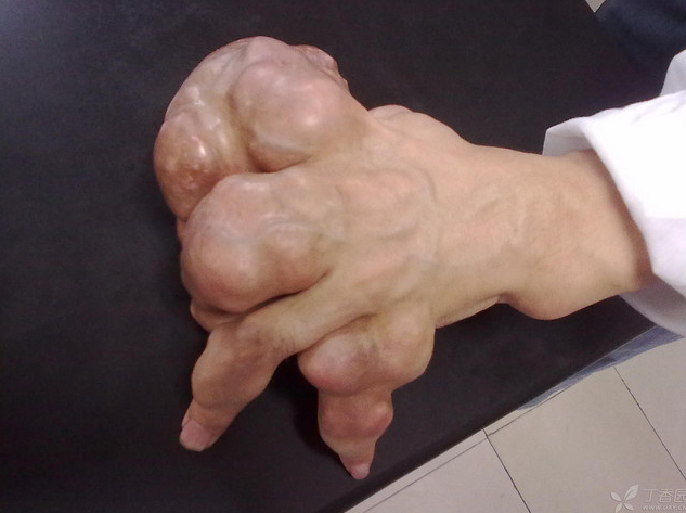 中年男子左手多发硬性肿块活动受限罕见的生姜手