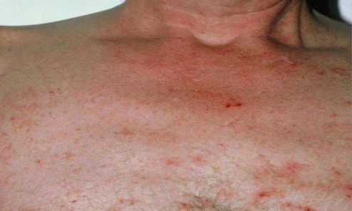 肝病症状早知道,身体出现这2变黄4变红应警惕!