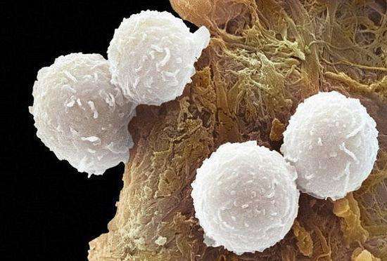 化学疗法|全球医权威报道：强化化疗对高危白血病儿童有治愈希望！