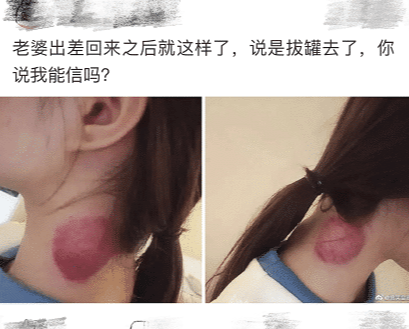"老婆出差回来就成这样子了,她说拔罐去了,我是不是被绿了?"哈哈哈哈