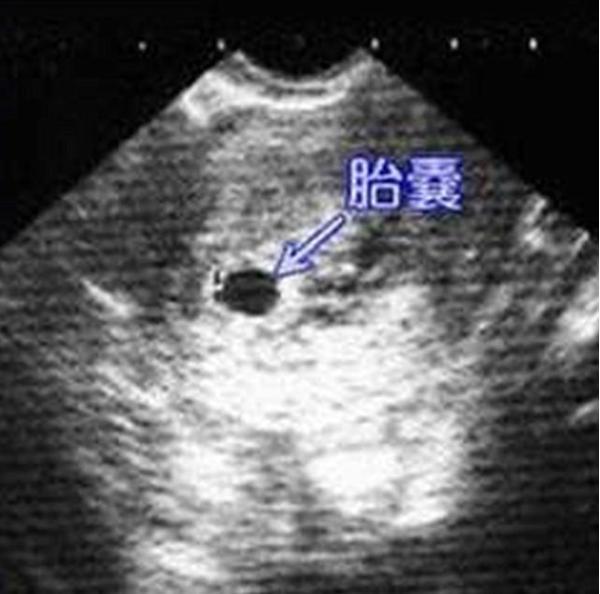 孕早期b超单据四个数据 表明孕妈 坐胎稳定 可以安心养胎 腾讯新闻