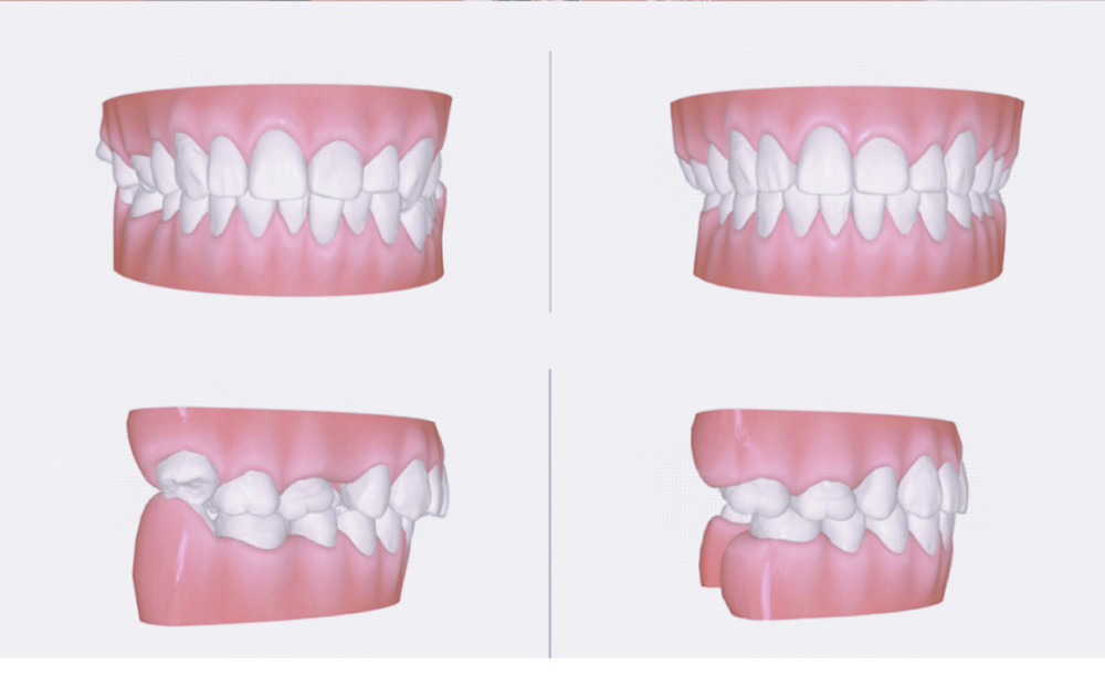 牙齿开合的矫正方法