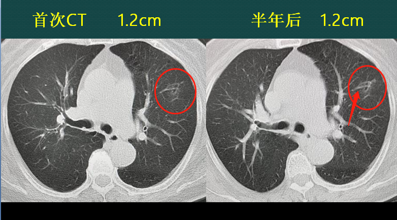 惡性肺結節,如果不重視ct定期複查,會發生什麼?