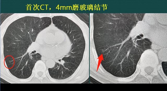 大家知道,純磨玻璃結節大多數是惰性病灶,生長很慢,但是少部分生長較