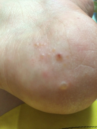 水泡型脚气用什么药这几个小偏方你到现在还不知道吗