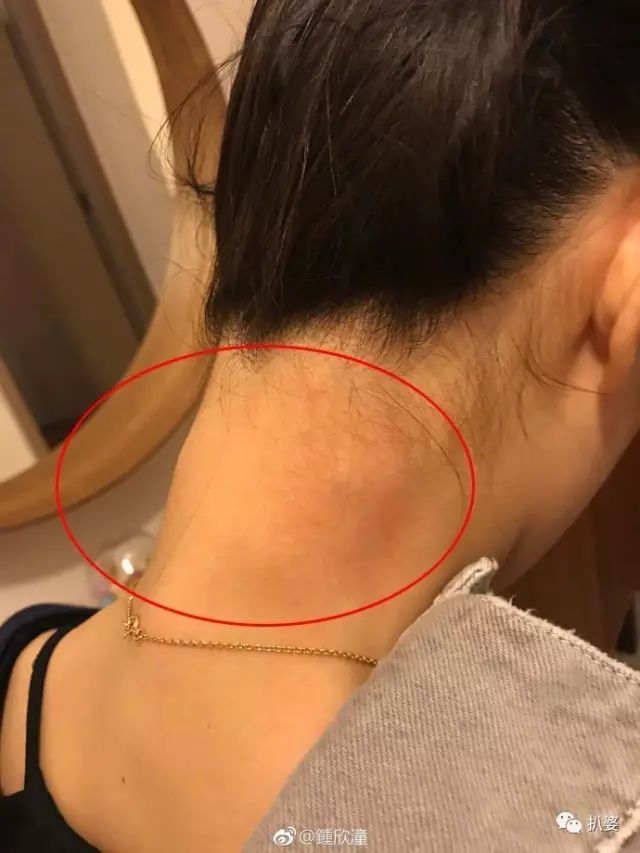 钟欣潼|离奇受伤的阿娇，又有新故事了