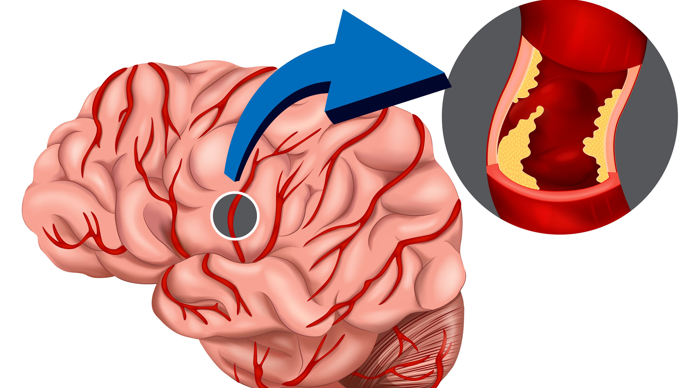 脑梗死|人到中年，不想脑梗死，远离一物，做到二个坚决，让你生活更健康