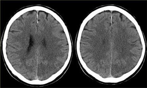脑梗死|人到中年，不想脑梗死，远离一物，做到二个坚决，让你生活更健康